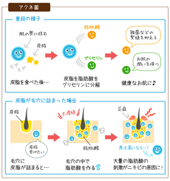 アクネ菌